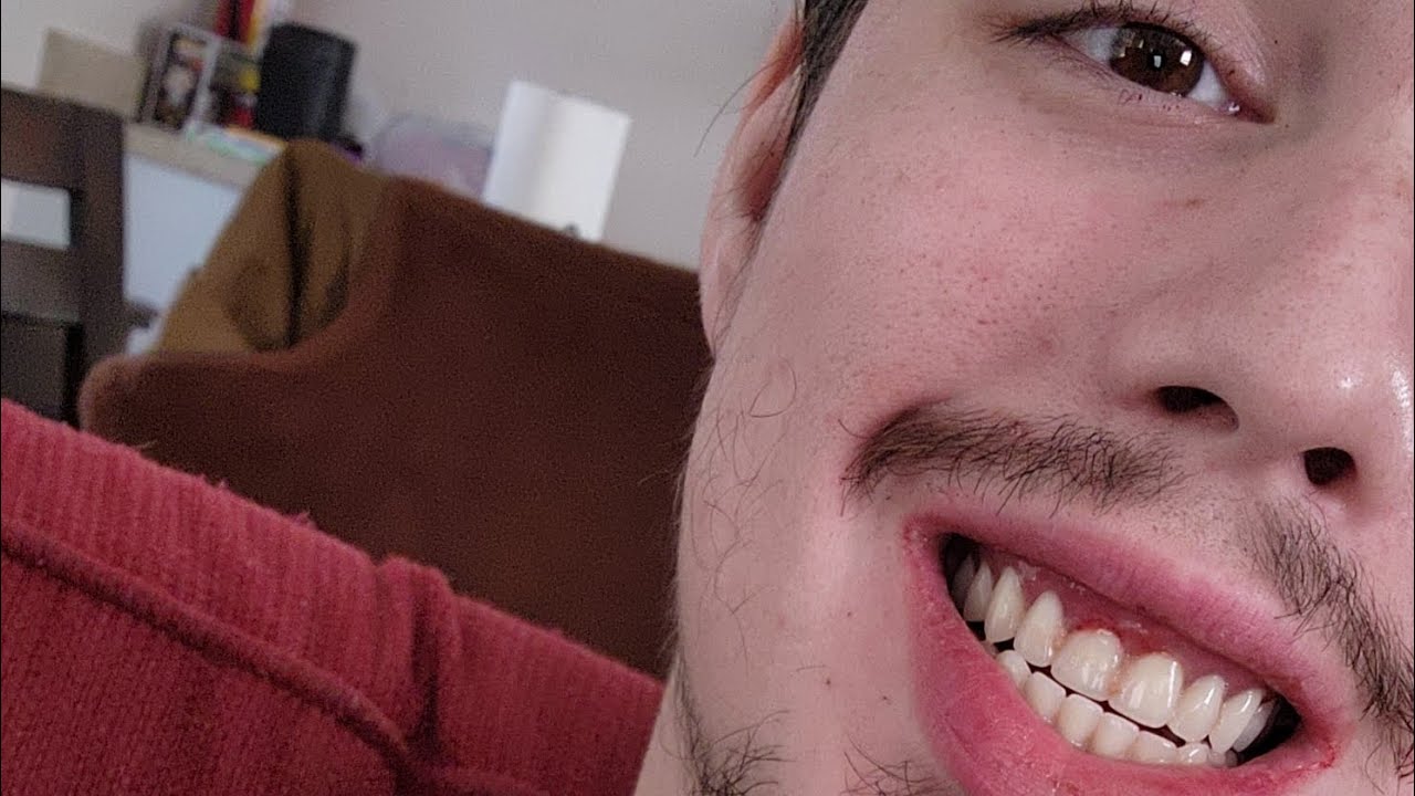 Surgery day, 32 teeth extraction bone grafted, complete dentures quit smoking and drinking