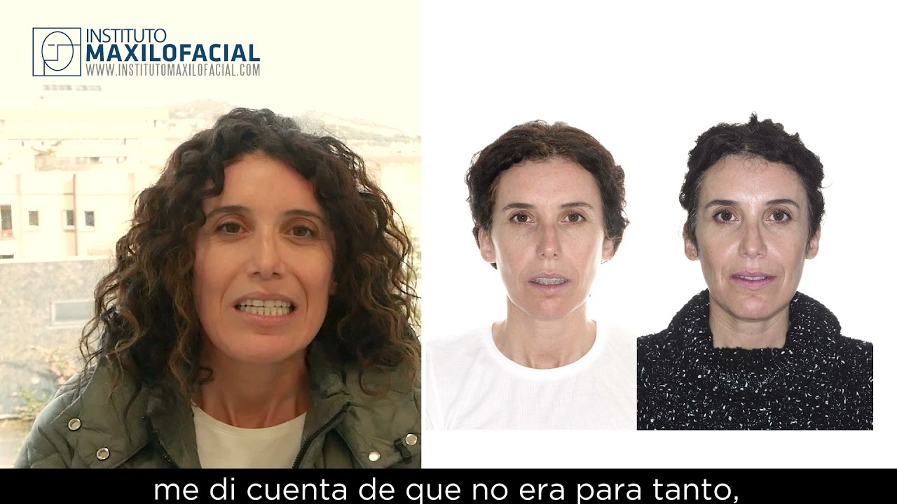 Cirugía ortofacial. Caso # 89: Ana - Clase II, biretrusión, incompetencia labial (parte 1 de 2)