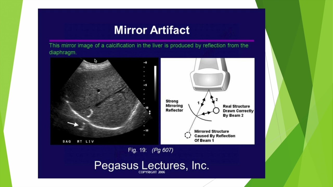 Artefacts et échographie: le miroir!