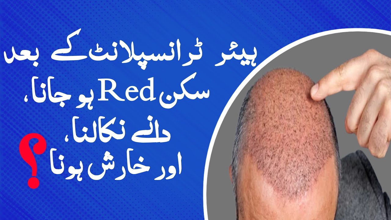 After Hair Transplant Skin Redness, Acnes and Itching | Dr. Habib Ullah Shah