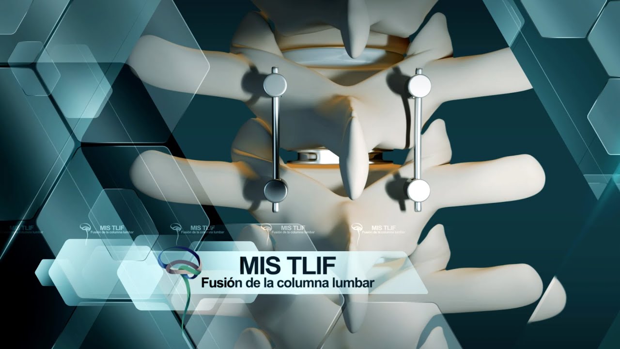 Artrodesis lumbar | MIS TLIF