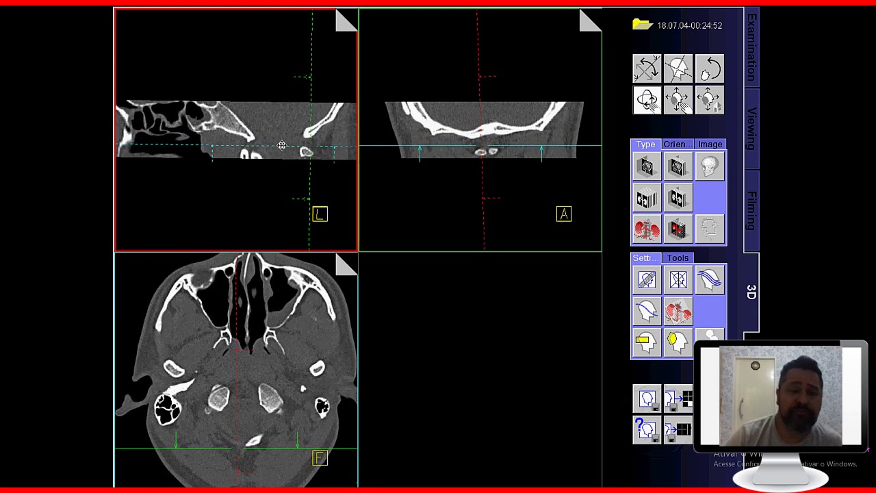 TOMOGRAFIA DE ATM (ARTICULAÇÃO TEMPOROMANDIBULAR)