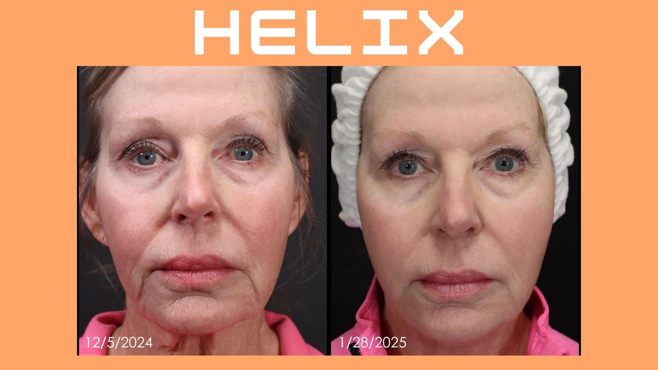 Unlock Youthful Skin with Helix Laser: The Game-Changer You’ve Been Waiting For!