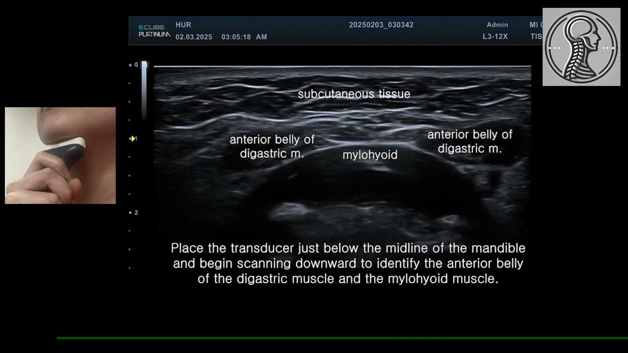 Ultrasound of the digastric, mylohyoid, and submandibular gland. Courtesy of Dr.Mi-Sun Hur.