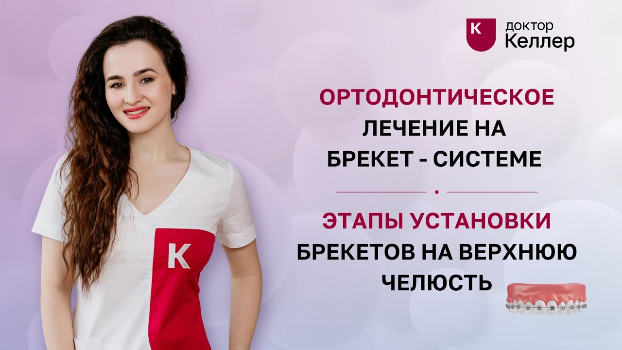 Ортодонтическое лечение на брекет системе. Этапы установки брекетов на верхнюю челюсть
