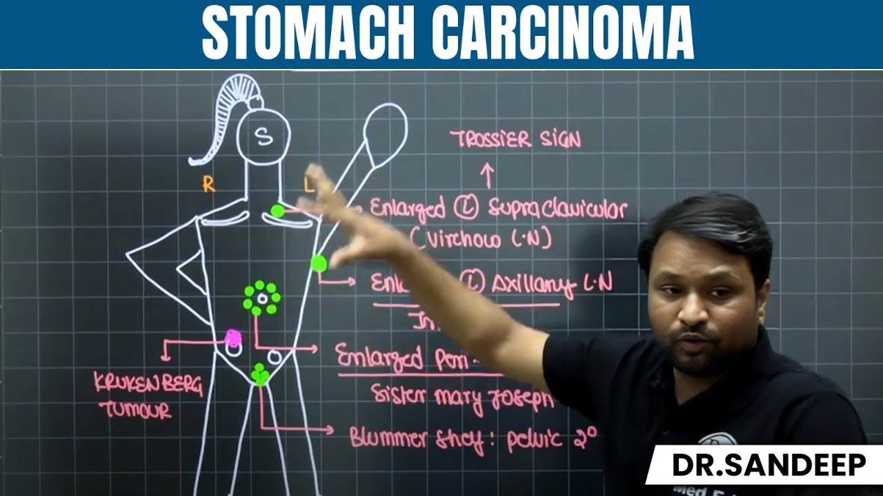 Stomach Carcinoma | Surgery | Bailey learned with Dr. Sandeep | PW MedEd