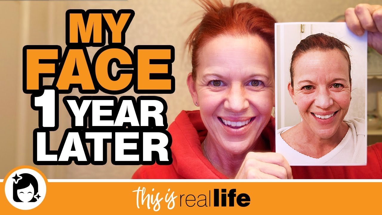 My Face 1 Year Later - THIS IS REAL LIFE