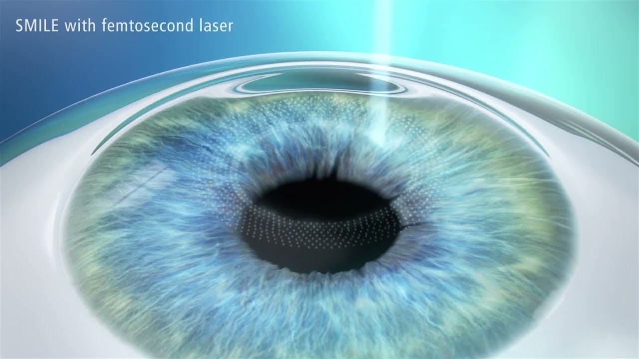ZEISS SMILE Pro - Vision Correction Surgery | Coastal Vision Medical Group