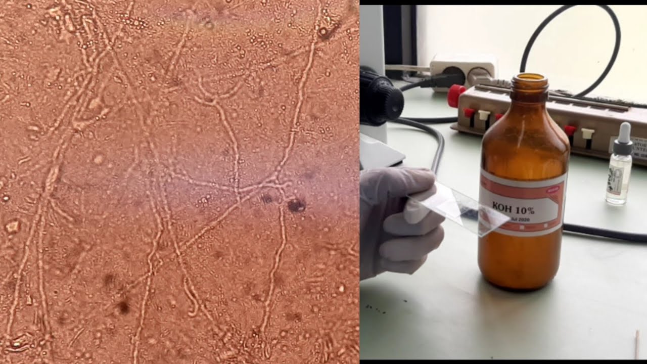 Membuat Sediaan Kerokan Kulit Untuk Pemeriksaan KOH Sebagai Penunjang Diagnosis Tinea Korporis