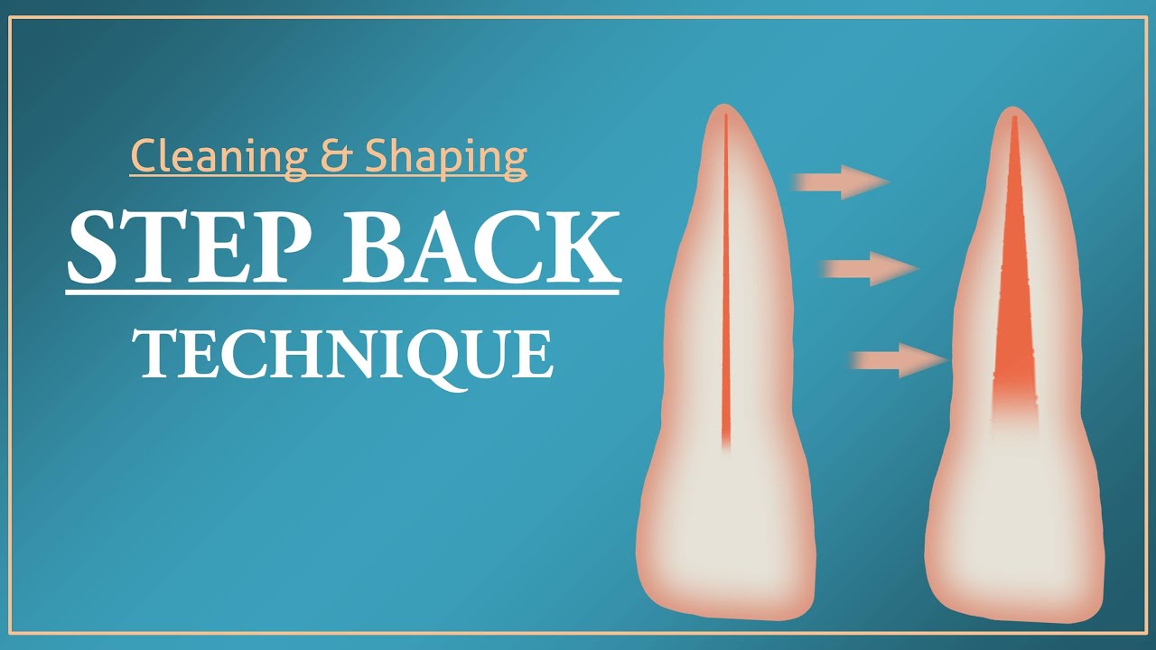 Step Back Technique | Root Canal Treatment