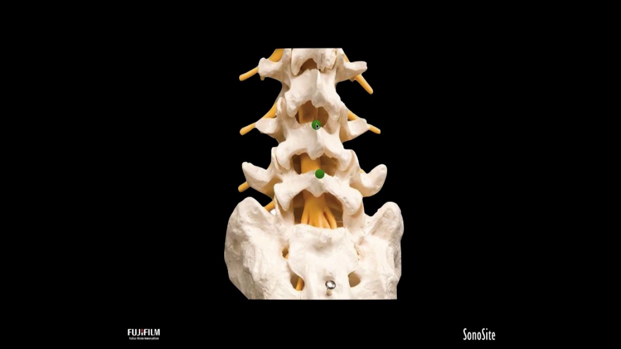 Webinar: Ultrasound for Neuraxial Analgesia/Anesthesia