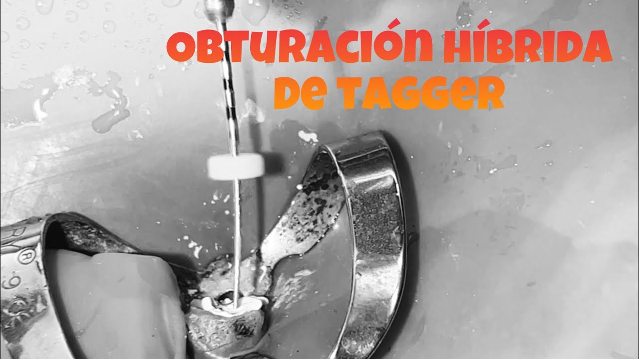 Técnica híbrida de tagger / termomecánica canino superior