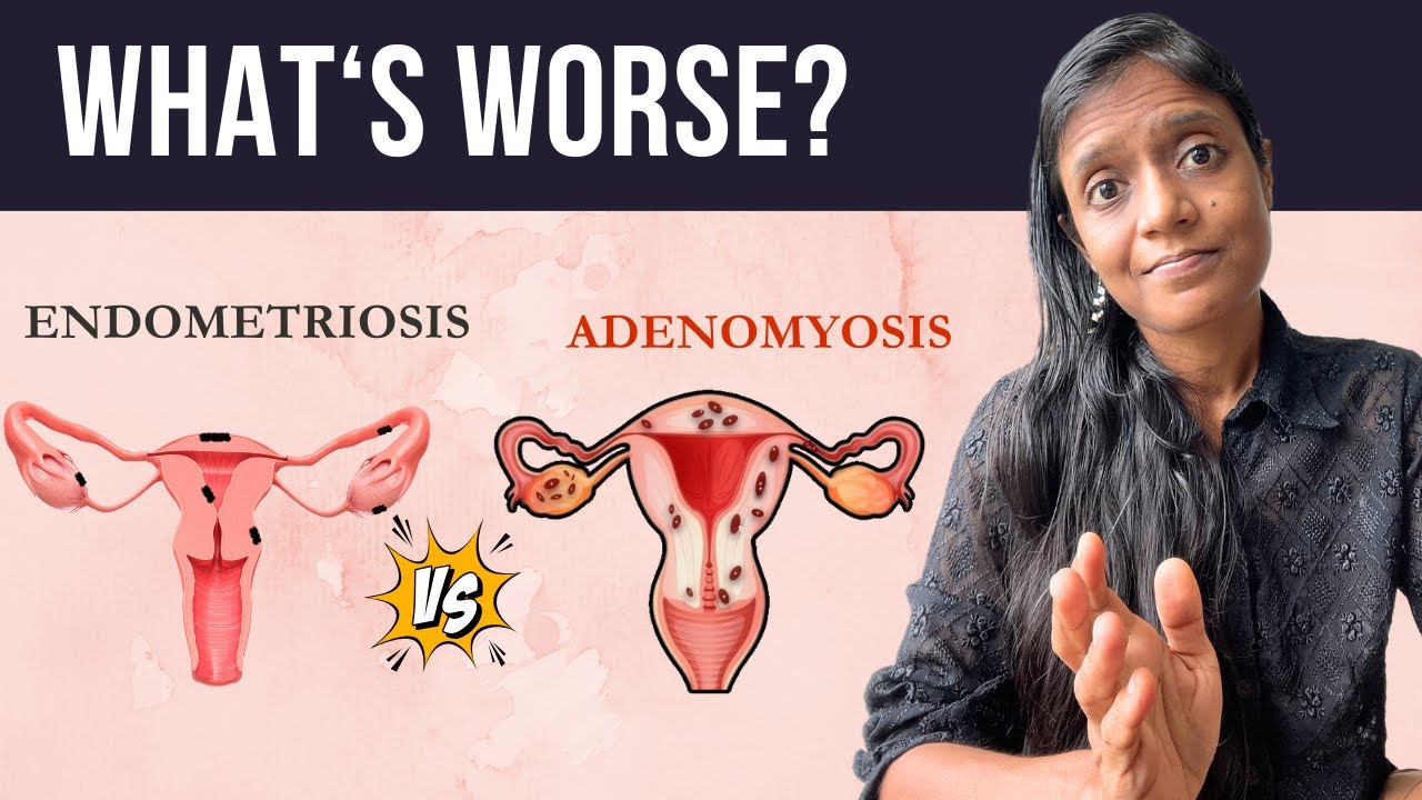 Adenomyosis Vs Endometriosis: What's the Difference?