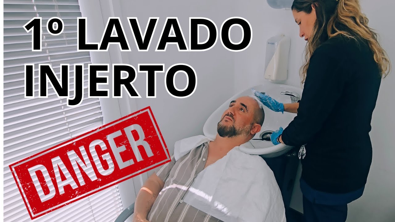 ¿Es Seguro el primer LAVADO después de un TRASPLANTE CAPILAR?