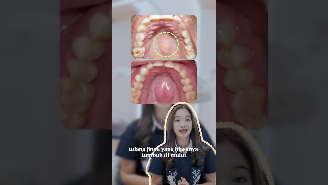 Tiba-tiba muncul benjolan kerasa di mulut? Jangan panik, siapa tahu itu Torus! Simak penjelasannya!