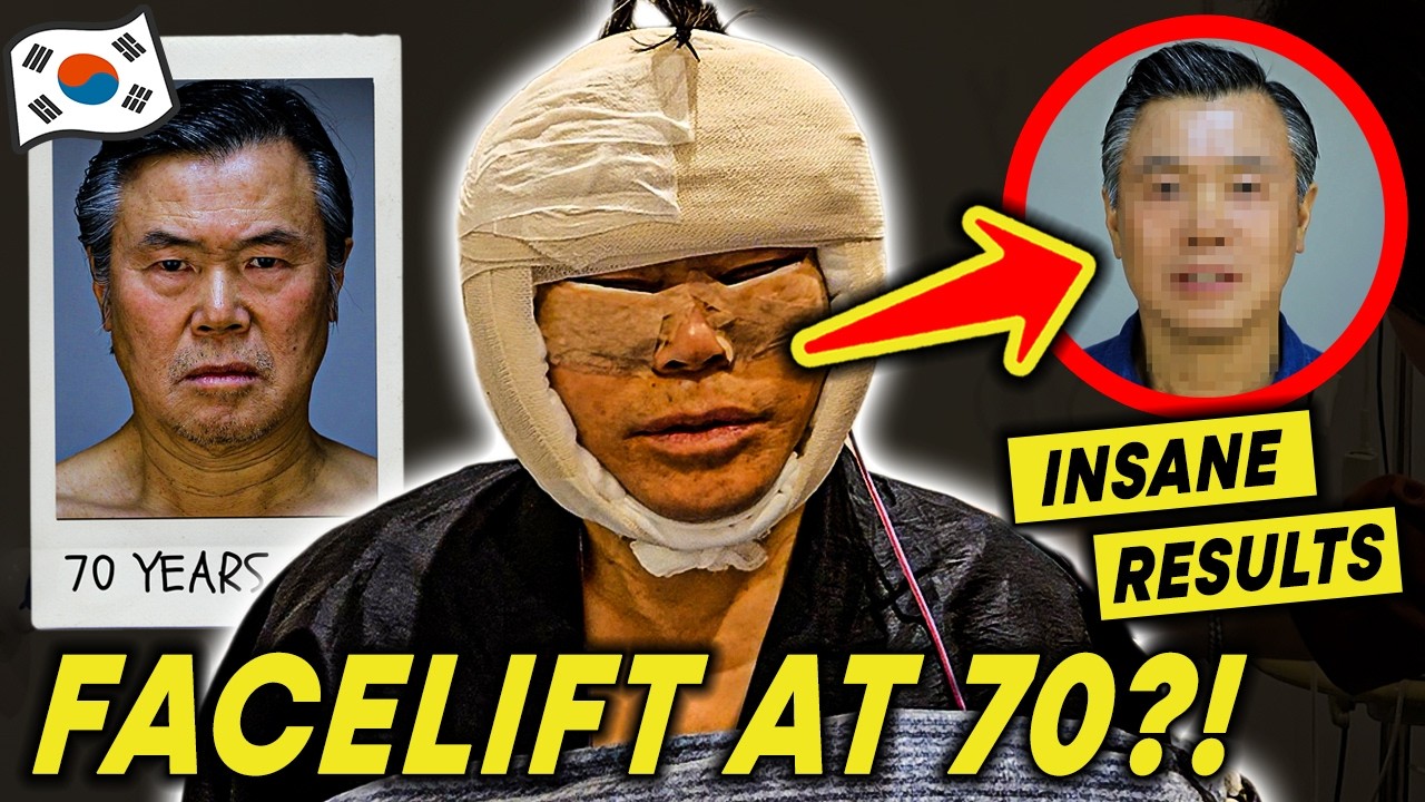 INSANE FACELIFT SURGERY Before & After!😱 Korean Facelift Men Vlog | Plastic Surgery in Korea