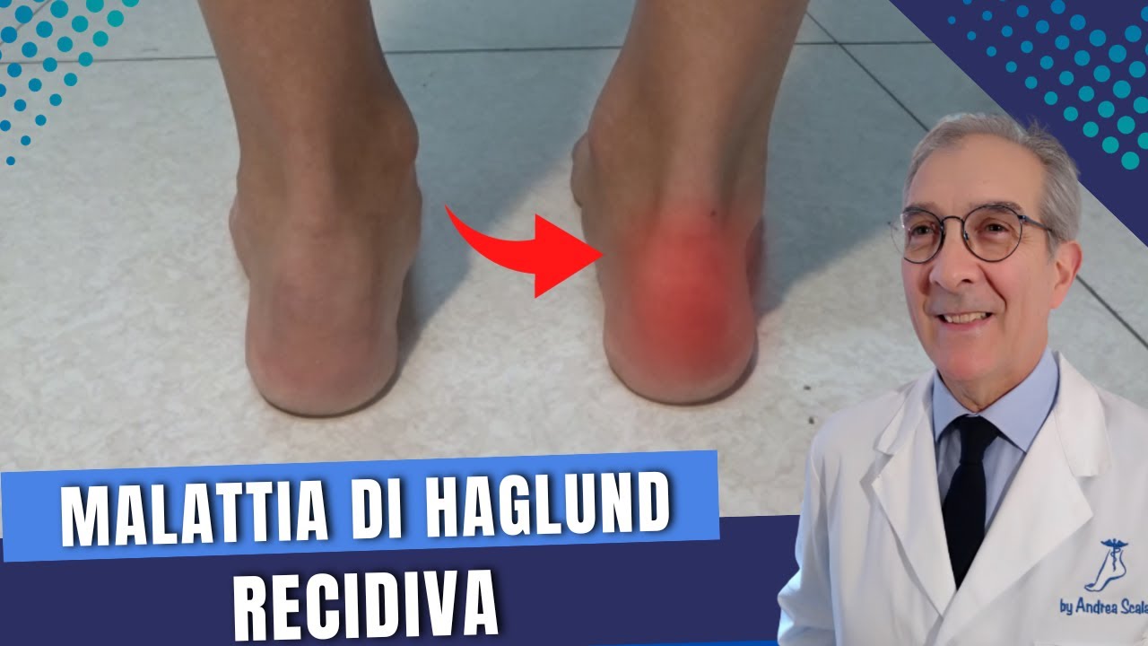 Malattia di Haglund RECIDIVA: cosa fare? | Dott. Andrea Scala