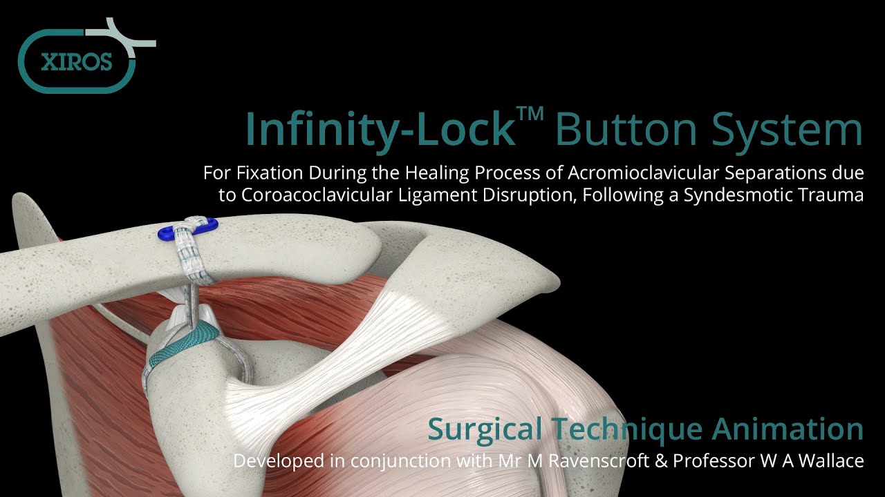 Infinity-Lock&trade; Button System Surgical Technique Animation