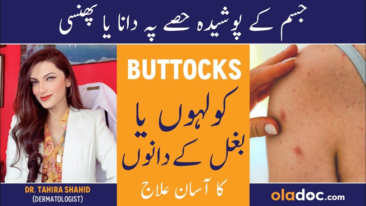 HOW TO REMOVE BUTTOCKS ACNE - Baghal Men Dana Nikalna - Hips/Underarm Pimple Treatment In Urdu/Hindi