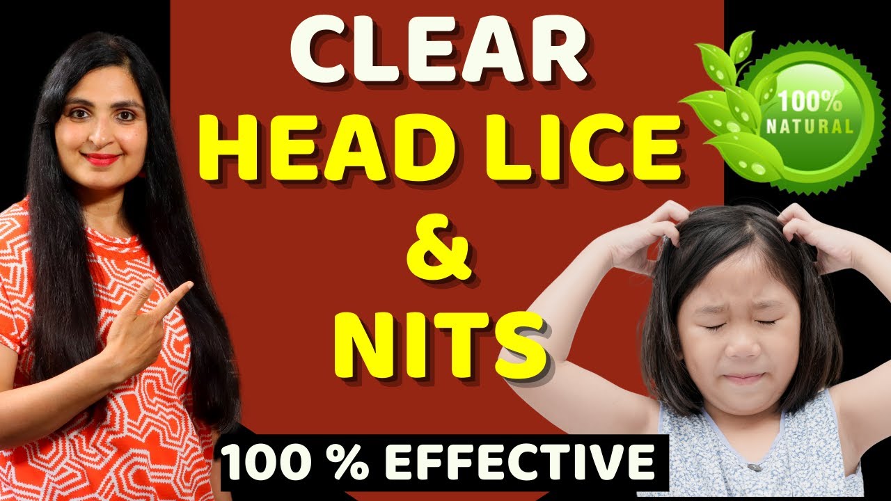 HOW TO REMOVE HEAD LICE  & NITS / Treat Lice Without Chemicals / Natural Remedy/ #Headlice #Haircare