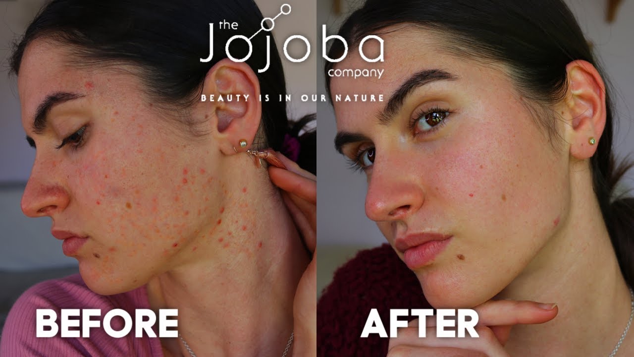 I CLEARED MY ACNE IN UNDER 8 WEEKS!💛Jojoba Skincare Review