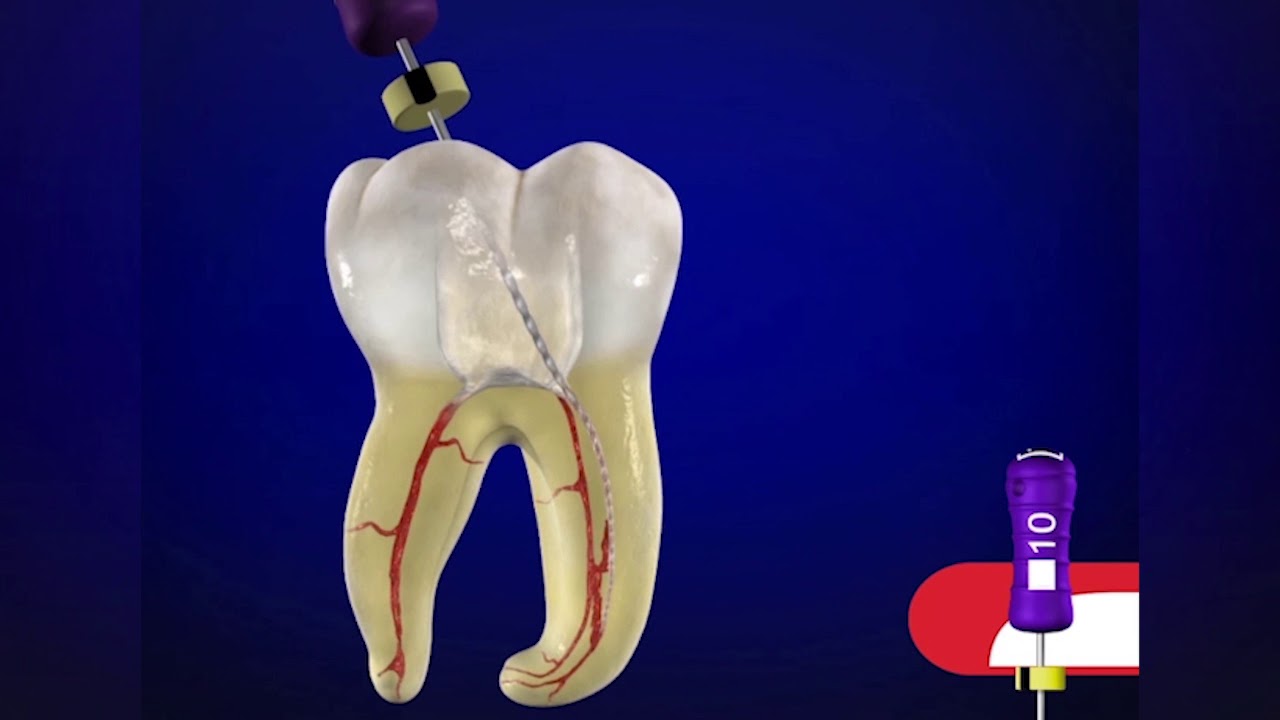 ProTaper Gold&reg; SX file with Dr. Cliff Ruddle | Dentsply Sirona