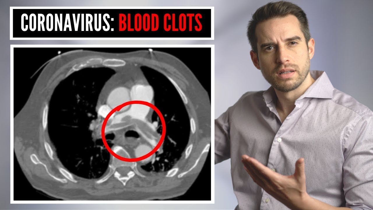 Are BLOOD CLOTS the reason why COVID patients are dying? | Blood thinners to save lives?