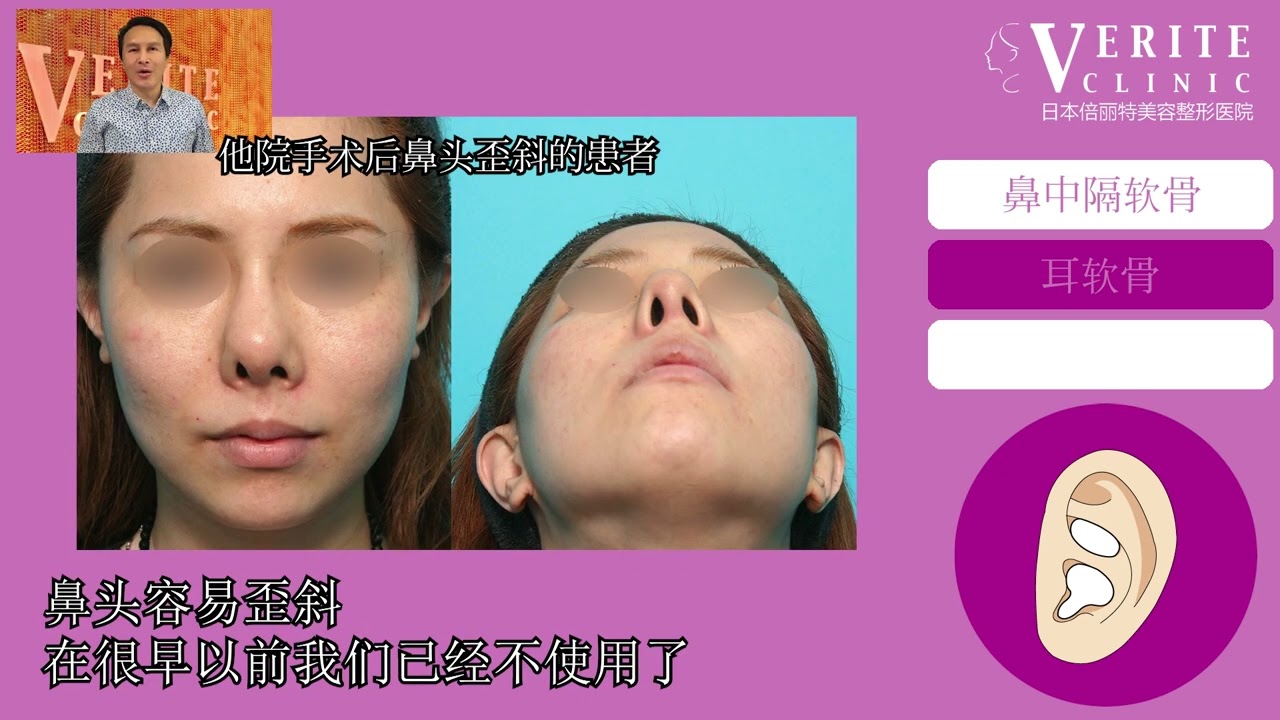 鼻中隔延长的发明者的新的研究和临床应用成果