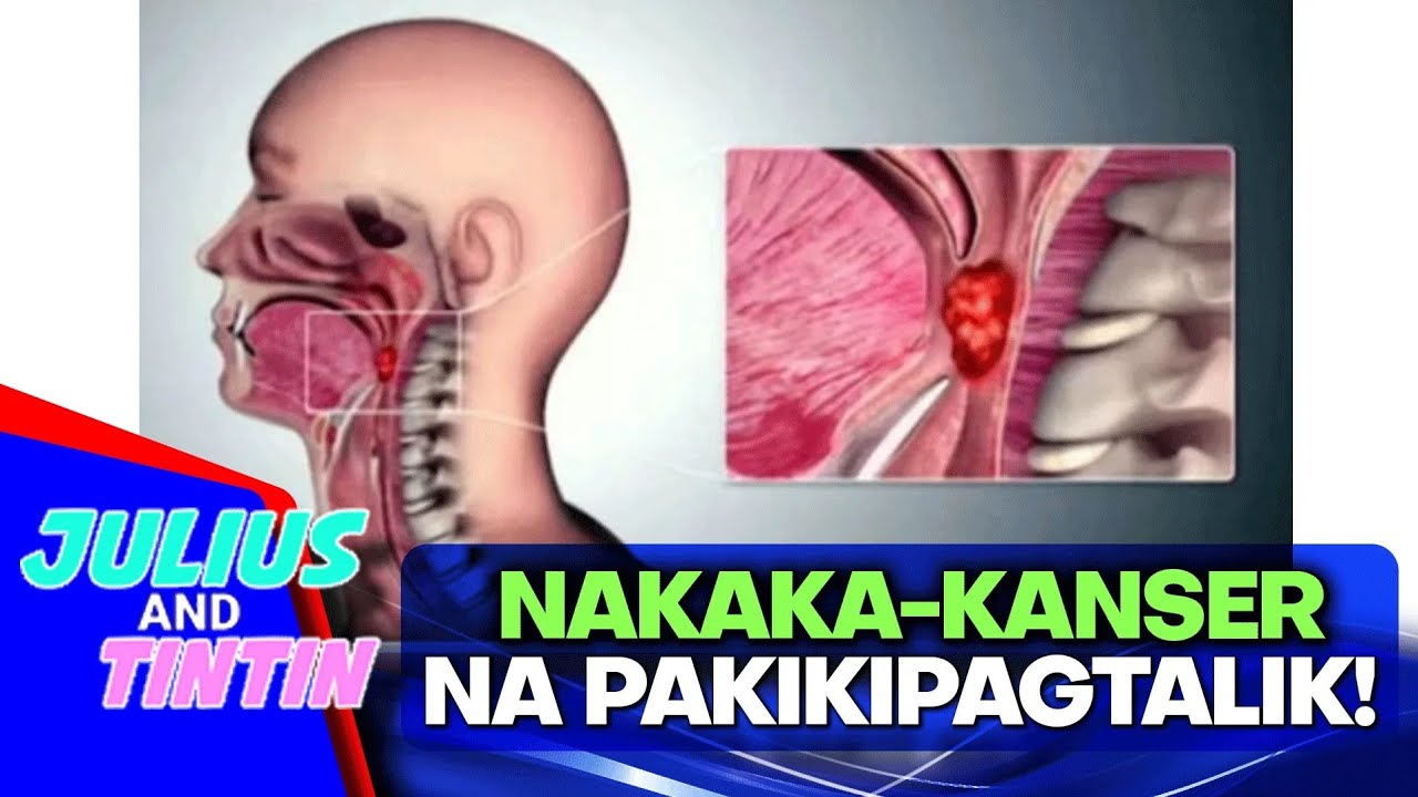 Signs ng throat cancer