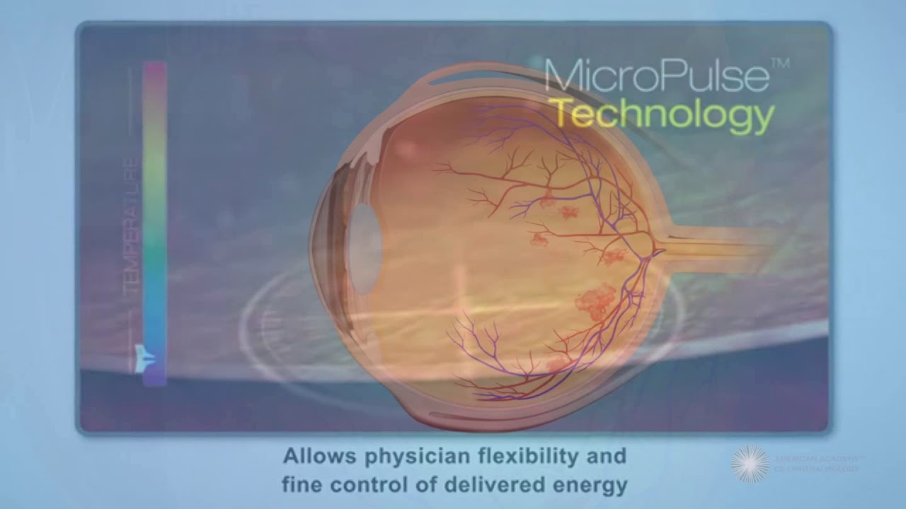 MICROPULSE LASER