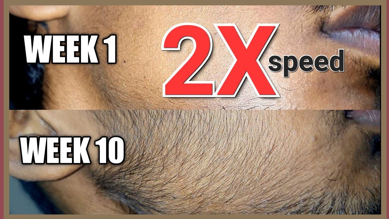 RE UPLOADING 3 MONTH MINOXIDIL5%BEARD GROWTH JOURNEY WEEK1 TO WEEK12 WITH 2X SPEED(SLOWER VERSION).