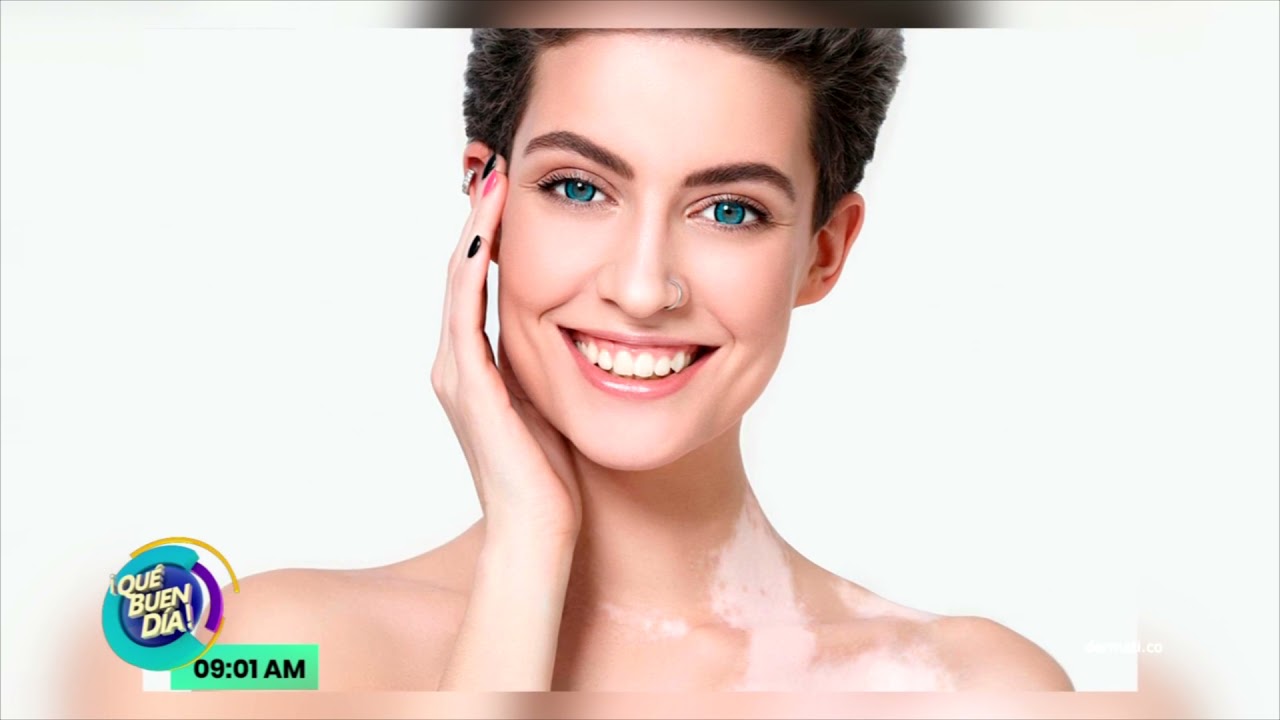Platicando Unos Datos Interesantes Sobre El Vitiligo
