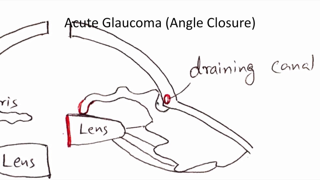 PLAB Opthalmology MCQs