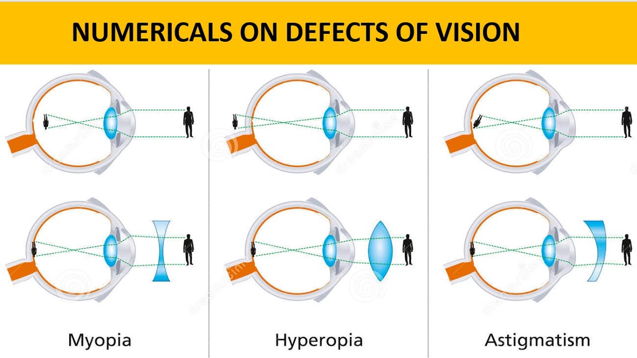 Ray Optics: Numericals on defects of vision