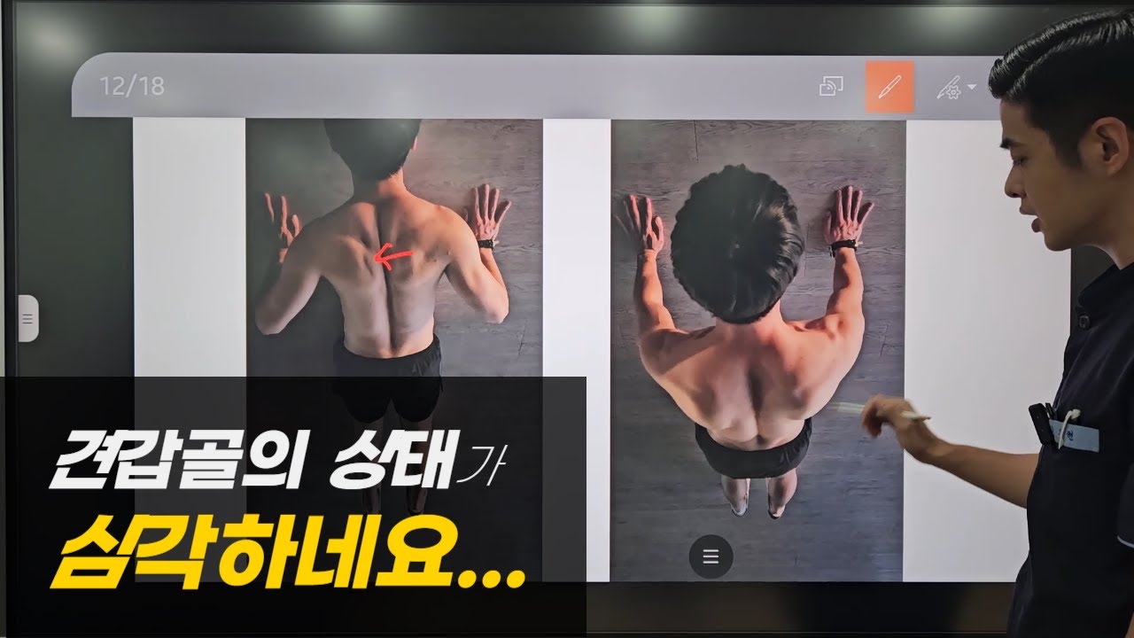 [어깨 재활 피드백] 견갑골의 기능이 심각한 상태입니다
