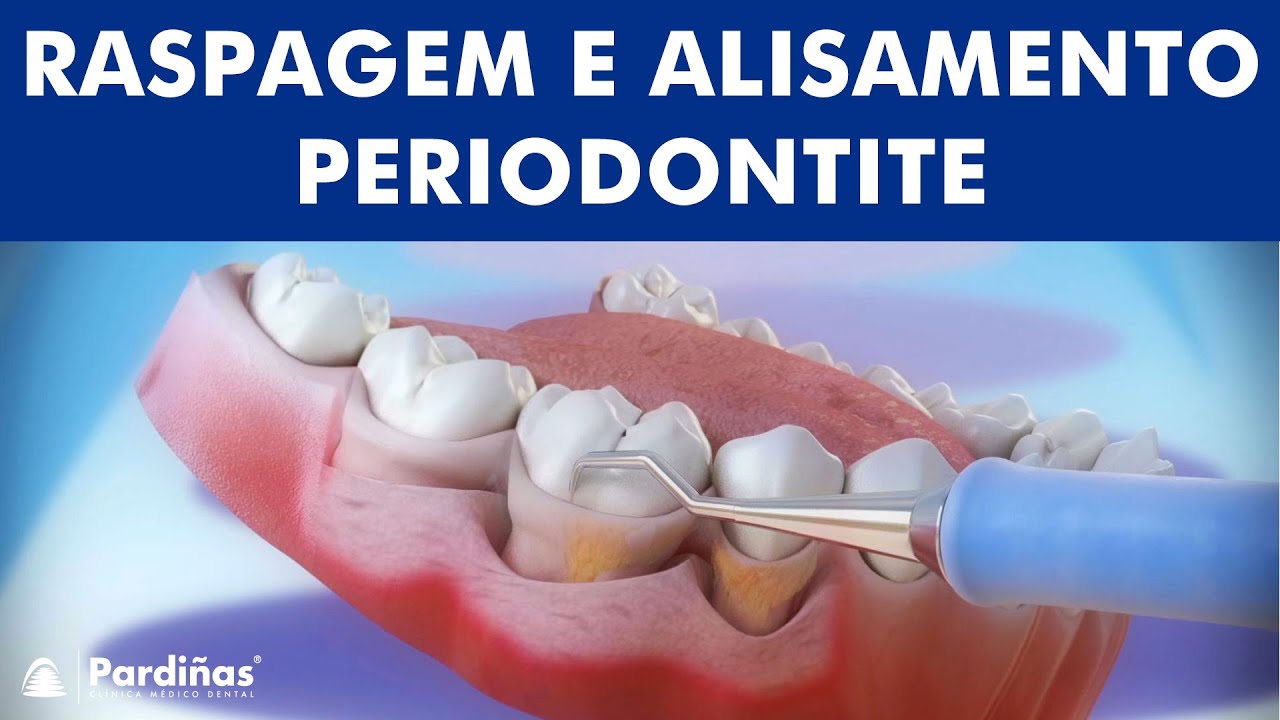 O tratamento da periodontite - Raspagem e alisamento ©