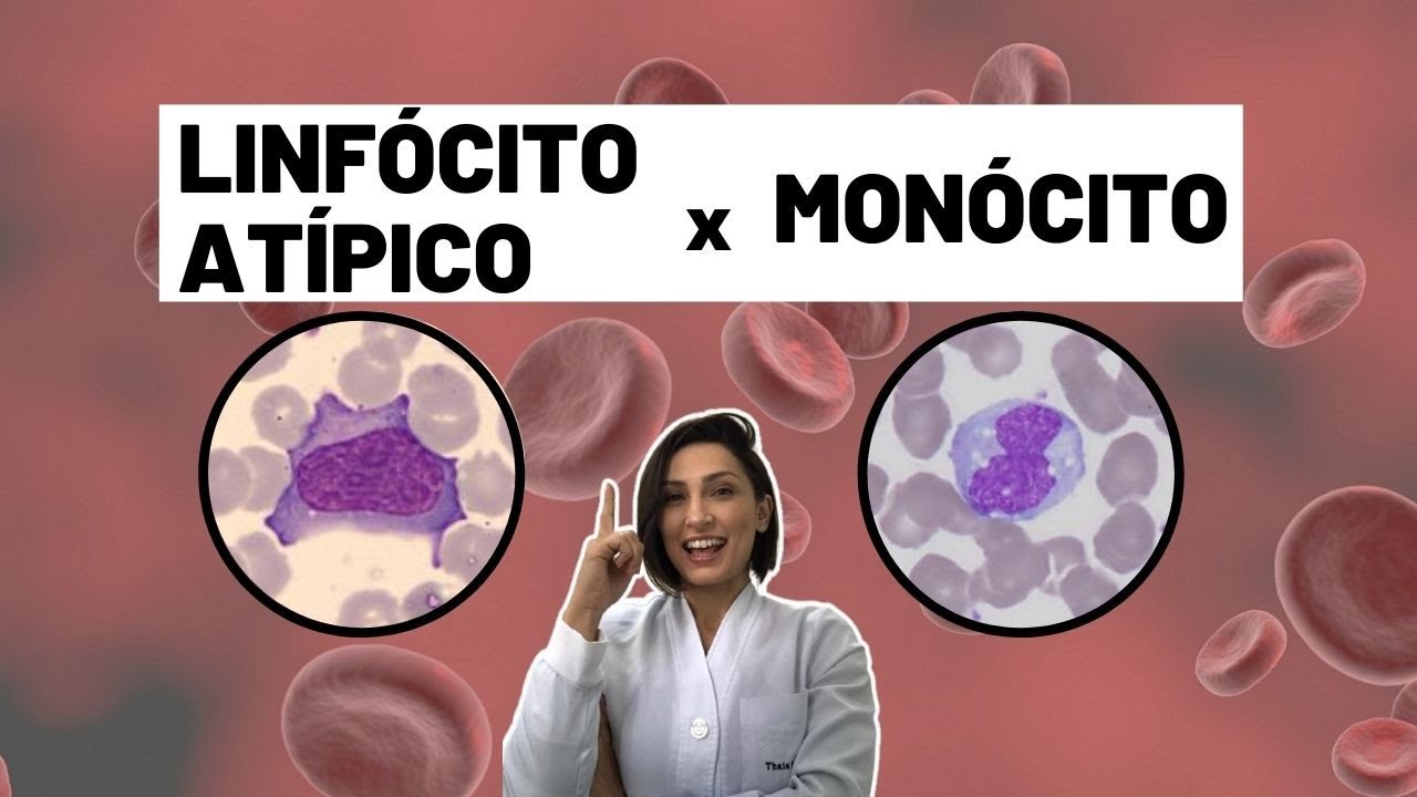 Como diferenciar linfócito atípico do monócito - Biomedicina - Hematologia