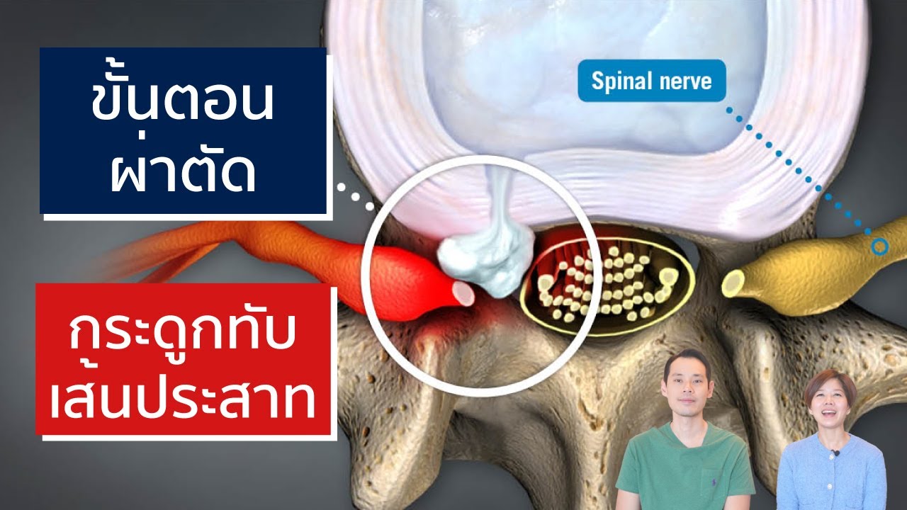 ผ่าตัดกระดูกทับเส้นประสาท ทำอย่างไร | EasyDoc  EP.26