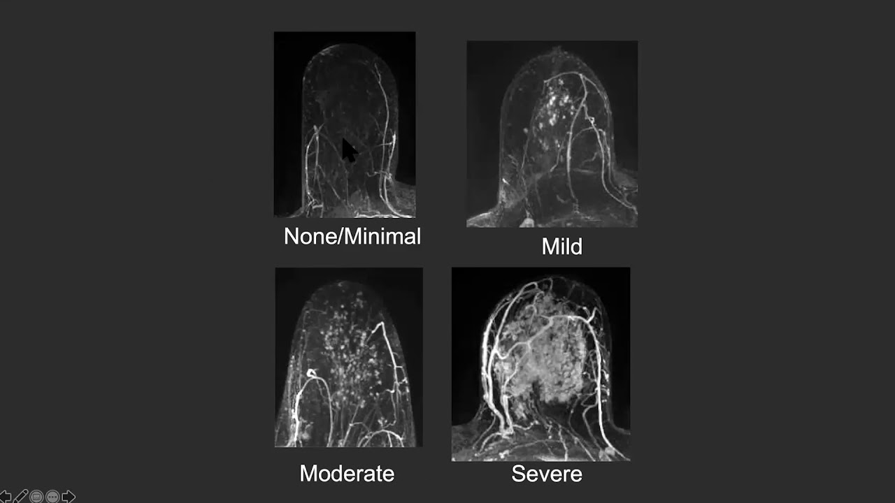 MR BIRADS, Dr. Petra J. Lewis - MRI Online Noon Conference