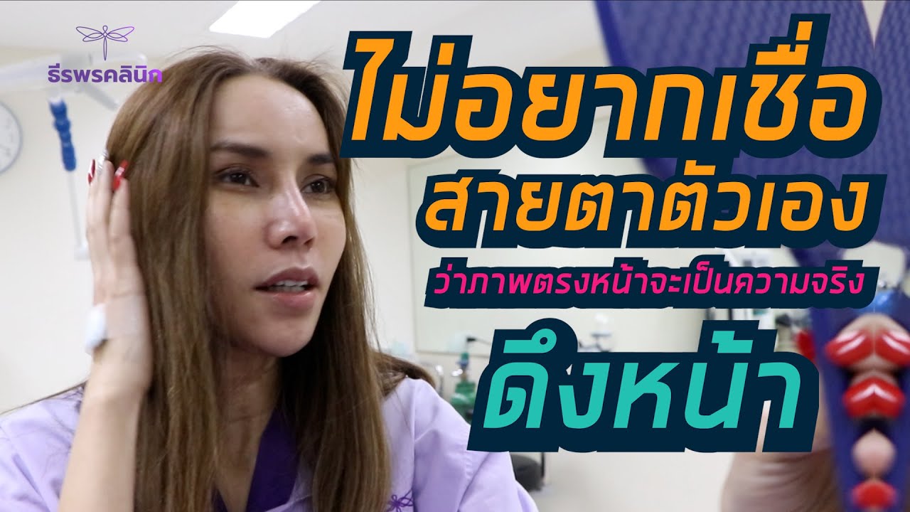 สดจากห้องผ่าตัดดึงหน้าเฟซล็อคสาวใหญ่วัย 51 ปี ธีรพรคลินิก หมอชลธิศ