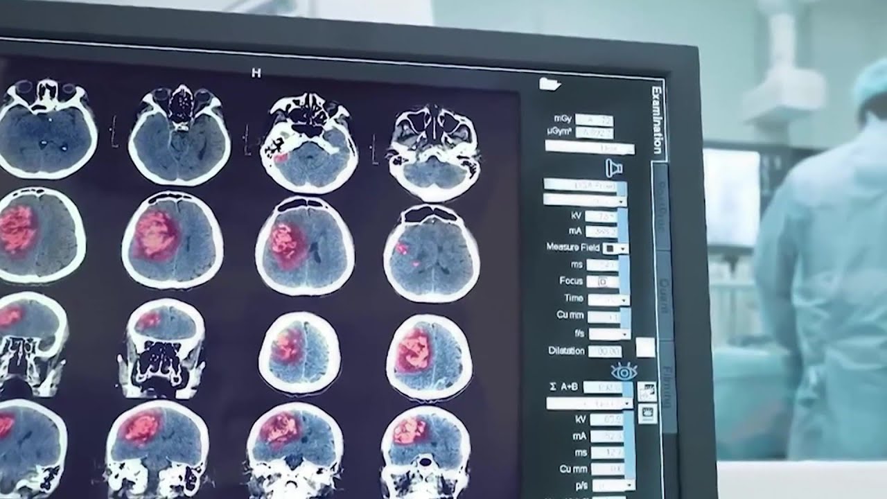 Diagnosis of AVM