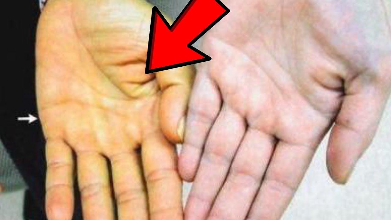 Qaraciyərimiz xəstədir? - Bu əlamətlərə DİQQƏT edin!