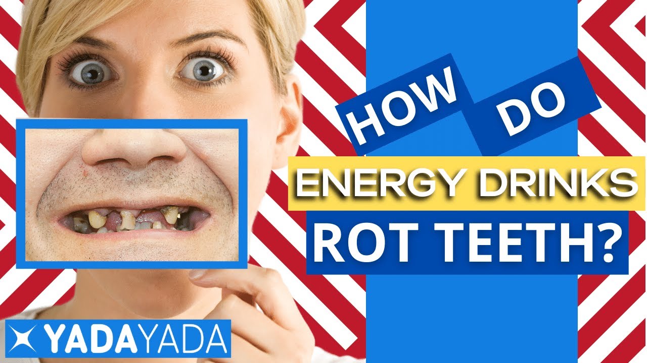Mountain Dew Mouth - Dental Help To Prevent Bad Teeth