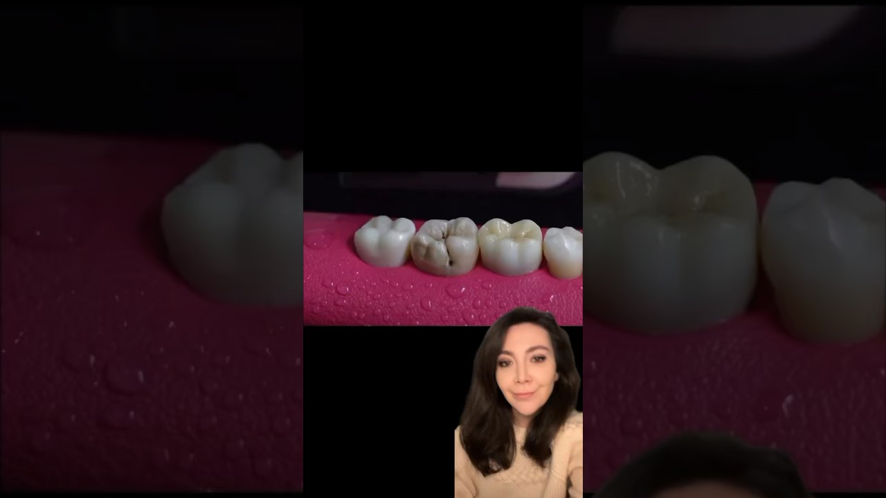 What Happens When you Need A Root Canal Treatment?!