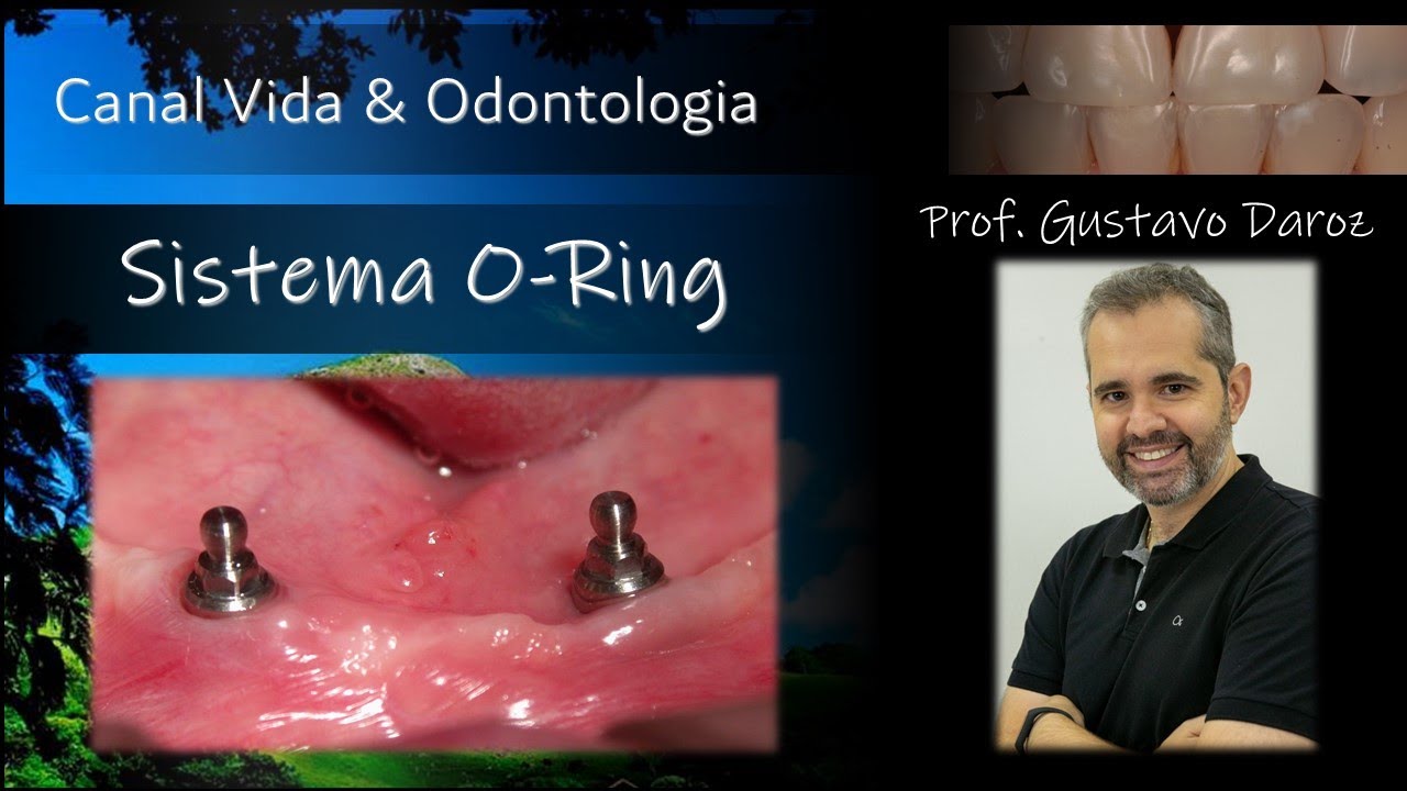 Sistema O-Ring para Retenção de Overdentures em Implantes Dentários