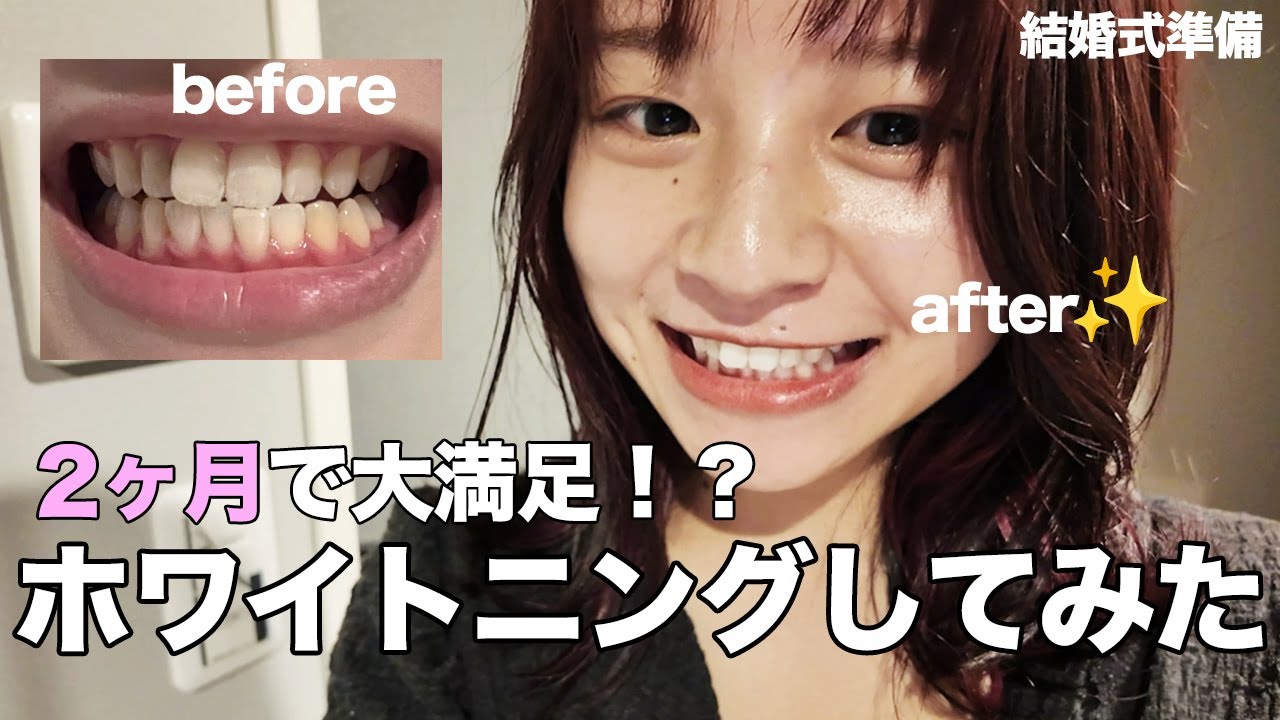 2ヶ月でここまで白くなった！私のホワイトニング記録🦷/ホワイトエッセンス/ウエディング/結婚式前美容