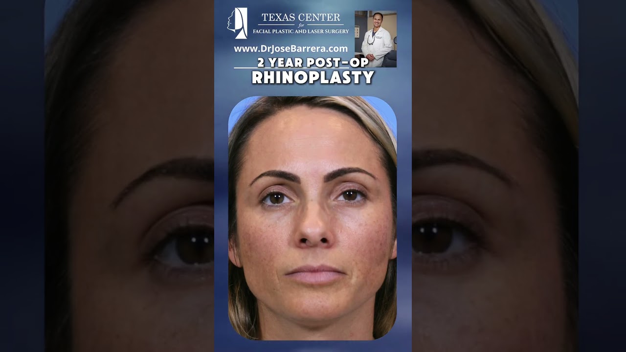 2-year post-op results for his female patient following Rhinoplasty & Septoplasty