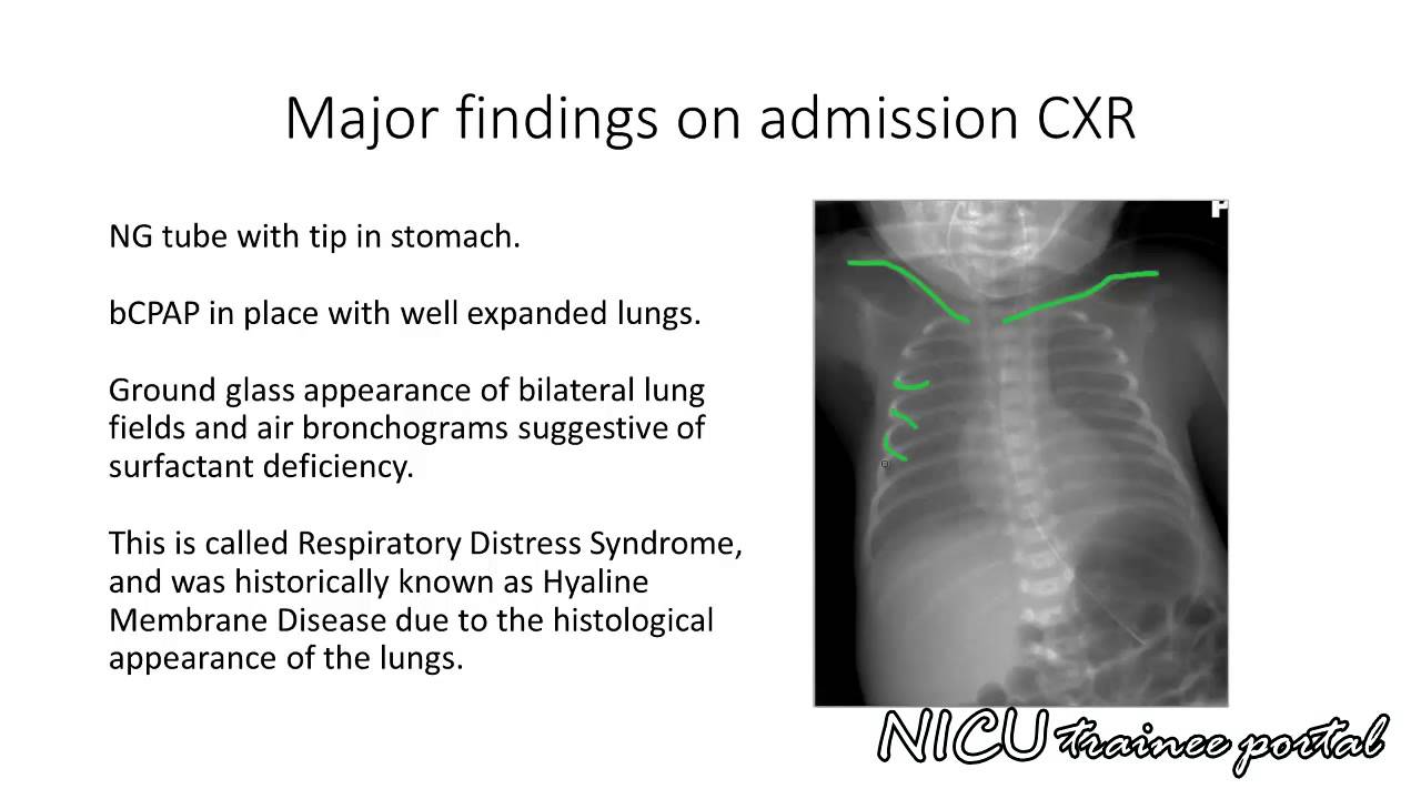 NICU Radiology Casebook: Respiratory distress in a 31.6 weeks gestation newborn twin infant