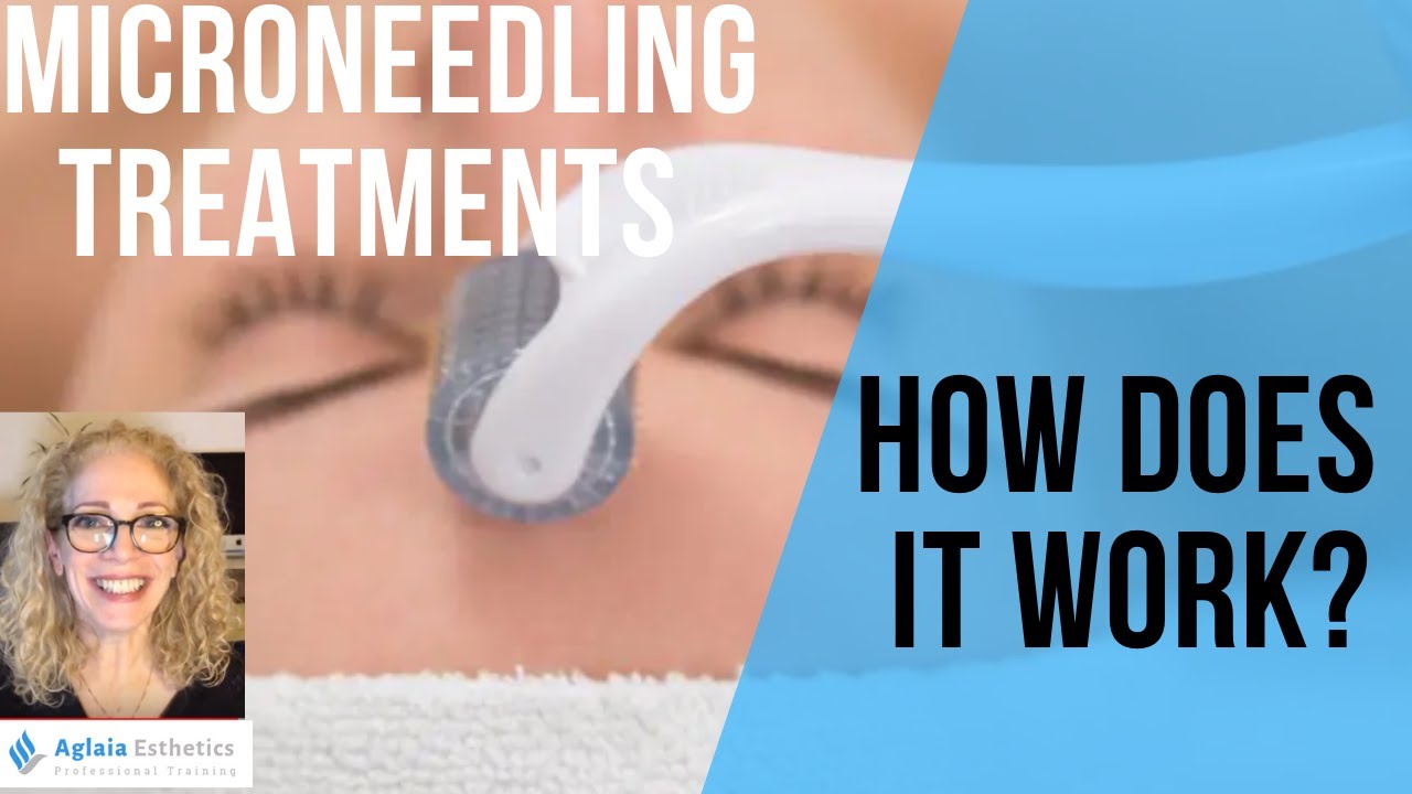 DOES MICRO-NEEDLING ACTUALLY WORK?