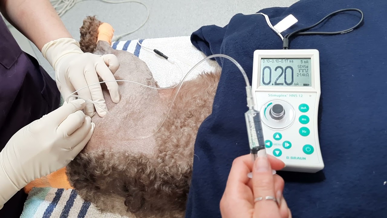 Nerve root blocks using nerve locator